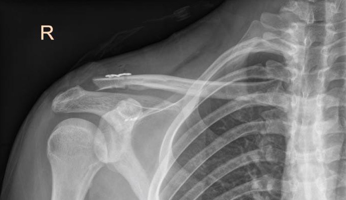 AC joint reconstruction AC joint injury, orthopaedic shoulder